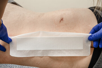 Nurse hand patching mole removal surgery incision as epidermal birthmark concept