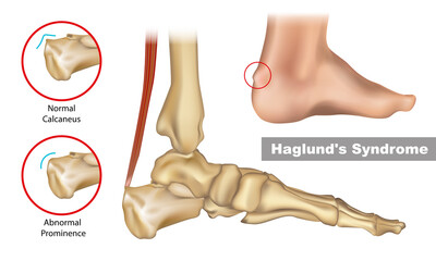 Haglund's deformity is an abnormality of the bone and soft tissues in the foot. An enlargement of the bony section of the heel. Haglund's syndrome. - obrazy, fototapety, plakaty