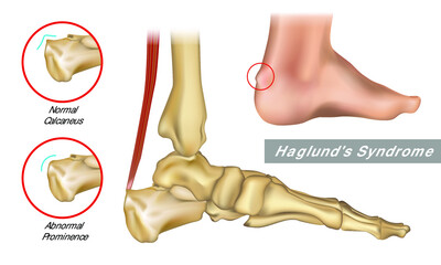 Haglund's deformity is an abnormality of the bone and soft tissues in the foot. An enlargement of the bony section of the heel. Haglund's syndrome.