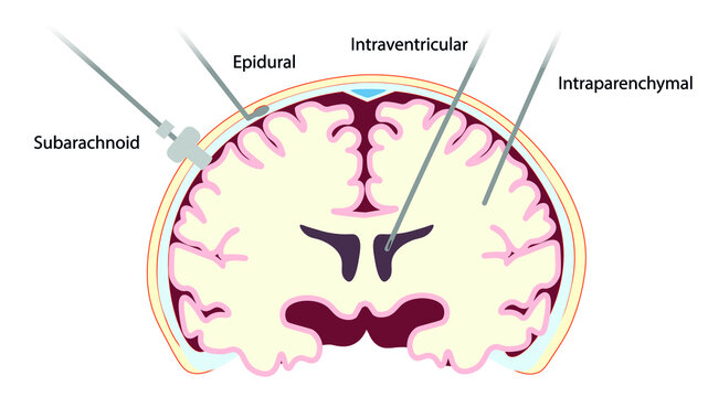 Intracranial Pressure Monitoring (ICP) monitoring device placement in a Coronal section.