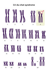 Human karyotype of Cri du chat syndrome. Autosomal abnormalities. A piece of chromosome 5 is missing