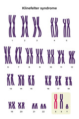 Human karyotype of Klinefelter syndrome. Klinefelter's, KS or XXY.