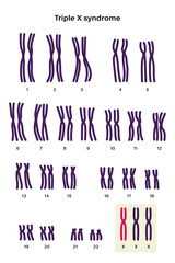 Human karyotype of Triple x syndrome. XXX. Female has an extra X chromosome.