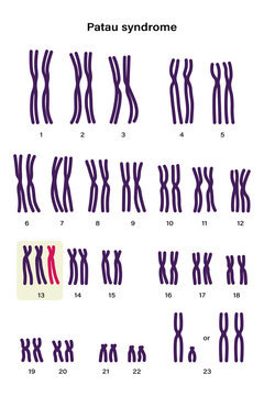 Human karyotype of Patau syndrome. Autosomal abnormalities. Patau syndrome have an extra copy of one of these chromosomes, chromosome 13. Trisomy 13, Genetic disorder 