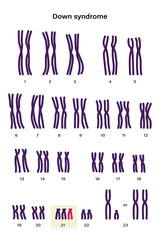 Human karyotype of Down syndrome. Autosomal abnormalities. Down syndrome have an extra copy of one of these chromosomes, chromosome 21. Trisomy 21. Genetic disorder