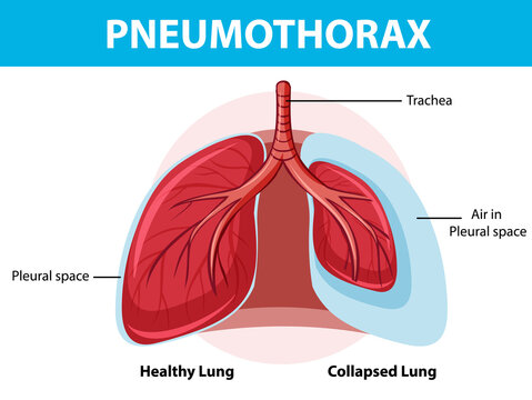 Pneumothorax diagram with collapsed lung and healthy lung