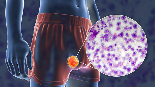 Testicular cancer, 3D illustration