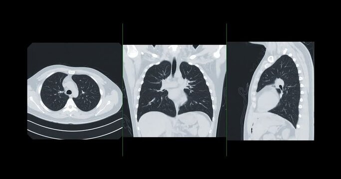 Collection of CT Chest or CT Lung axial, coronal and sagittal view for diagnostic lung diseases and covid-19.