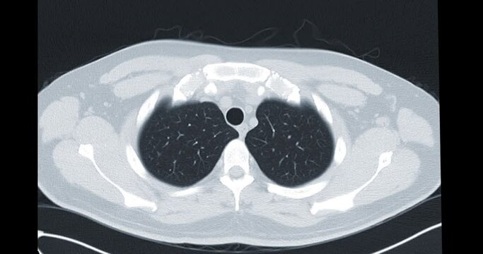 CT Chest or CT Lung axial mip view  for diagnostic lung diseases and covid-19.