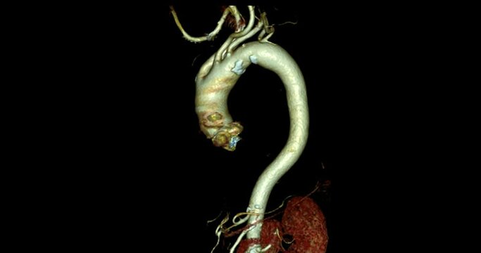  CTA thoracic aorta axial view for diagnosis aortic aneurysm.