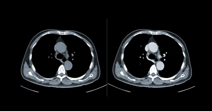 Compare of CT Chest or CT Lung axial view non contrast and injection contrast media for diagnostic lung diseases and covid-19.