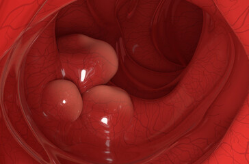 Large tumors on the colon wall in colorectal cancer closeup view 3d illustration