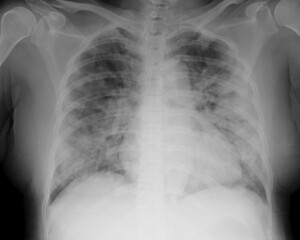   Chest x ray of covid 19 pneumonia radiology image