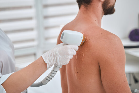 Patient getting a laser back hair removal