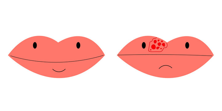 lips closeup with cold herpes, sore on the lip, vector illustration