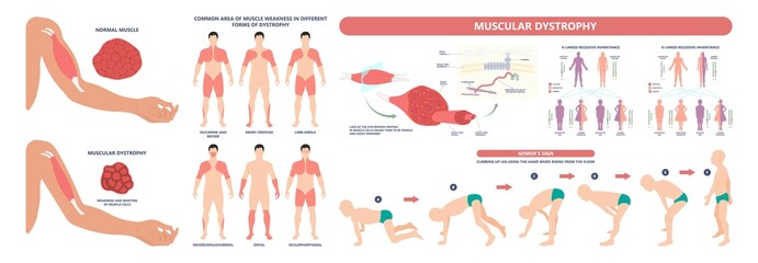 Muscle myopathy gene DNA cell damage Becker type Limb Girdle x linked Distal Emery loss Lack fibres tissue biceps arm spine weaken gait lumbar calf sign Gower lower exam fatigue Physical genetic stand