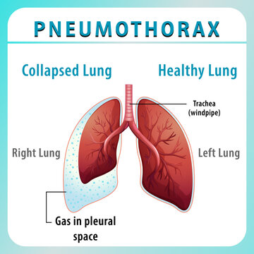 Pneumothorax diagram with collapsed lung and healthy lung