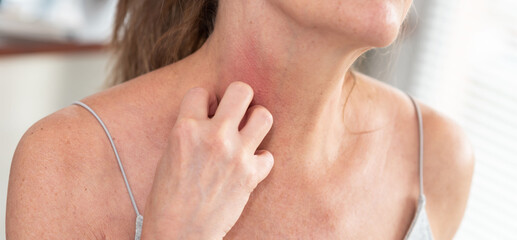 Woman having itchy and scratching her arm