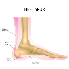 Heel spur on the foot. Anatomical representation.