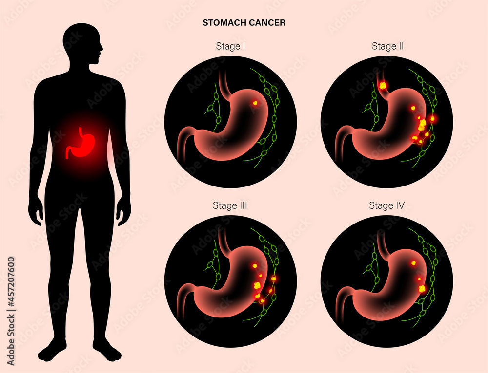 Poster Stomach cancer anatomy