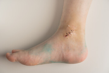 ankle wound with a suture after ankle fracture and removal of the cast.