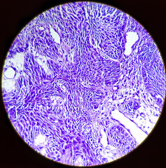 Cancer of Esophagus: Poorly differentiated adenocarcinoma in a patient. Tumor cells undermine the...