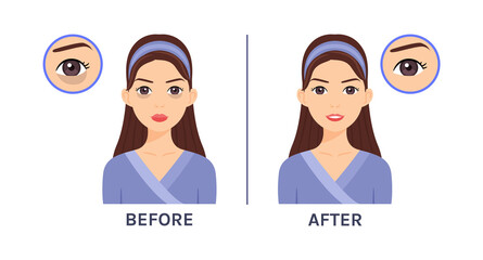 Young, Beautiful Woman with Dark Circles Under her Eyes. Icons. Treatment of Skin Around Eyes. Before and After. Health of Facial skin. Flat Cartoon style. White background. Vector illustration.
