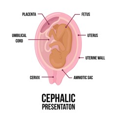 Latin arabian brown skin baby. Different wrong baby positions in uterus during pregnancy.