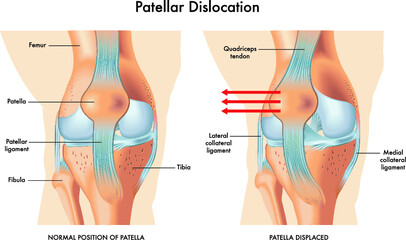 Medical illustration of symptoms of patellar dislocation, with annotations.