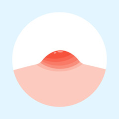 Flat vector illustration of pimple on skin. Pimple on face.