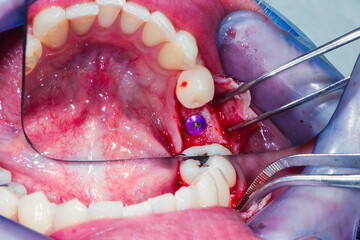 The gum is sutured with a special floss at the surgical incision to accommodate the dental implant.
