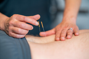 physiotherapy dry needling 