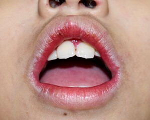 Angular stomatitis or angular cheilitis or perleche in asian little boy. Common inflammatory condition of angles of mouth.