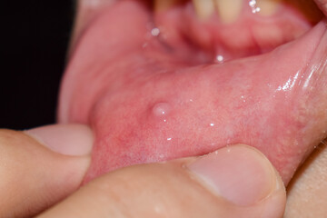 Small vesicle lesion at lower lip - obrazy, fototapety, plakaty