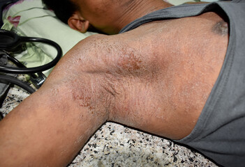 Scabies Infestation in arm and axilla area - obrazy, fototapety, plakaty