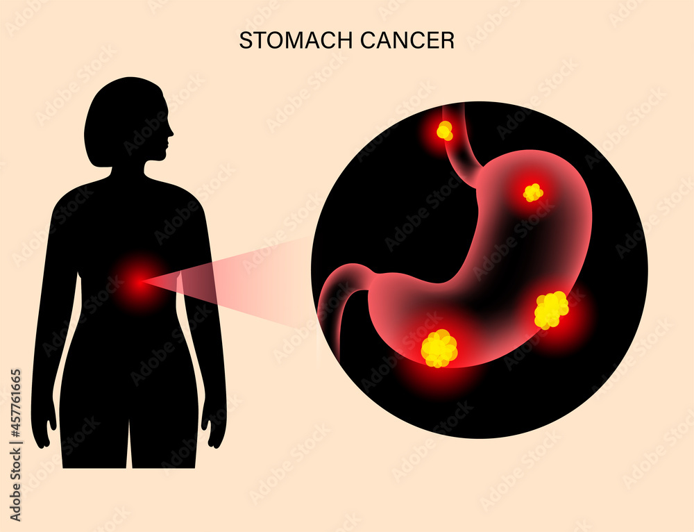 Wall mural Stomach cancer anatomy