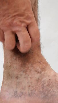 Human hands touch and crumple sore spotty leg of person suffering from blockage of veins, ulcers, dermatitis, eczema or other infectious diseases of dermatology. Close-up.
