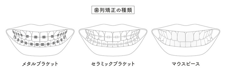 歯列矯正の種類　セットイラスト