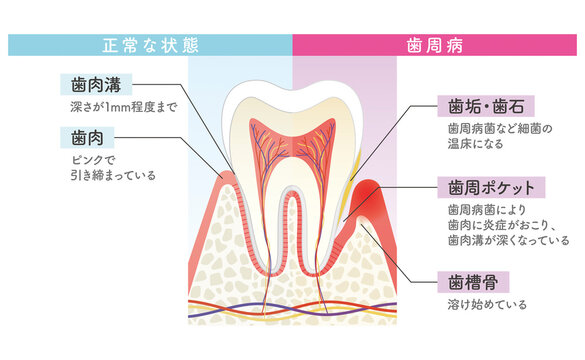歯周病と正常な状態の比較図