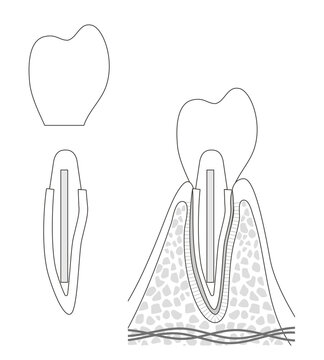 さし歯の構造イラスト