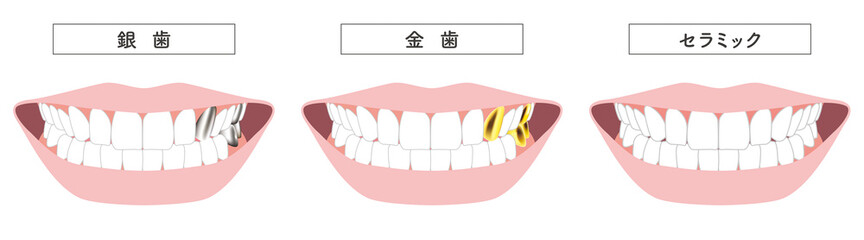 金歯　銀歯　セラミックのイラスト