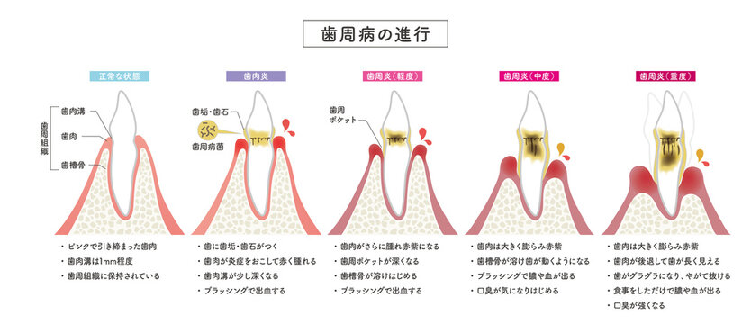 歯周病の進行