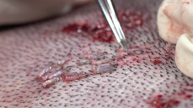 hair transplant