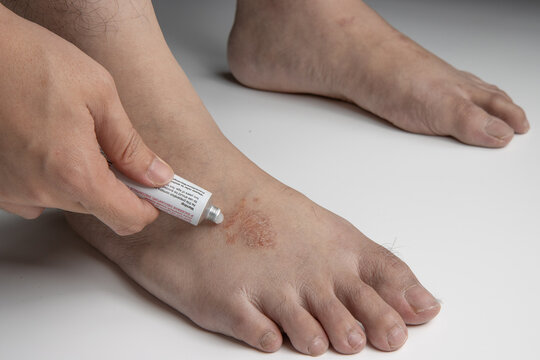 hand applying medication cream, gel or ointment on foot infected by ringworm, athlete's foot or tinea pedis fungal infection. on white background.