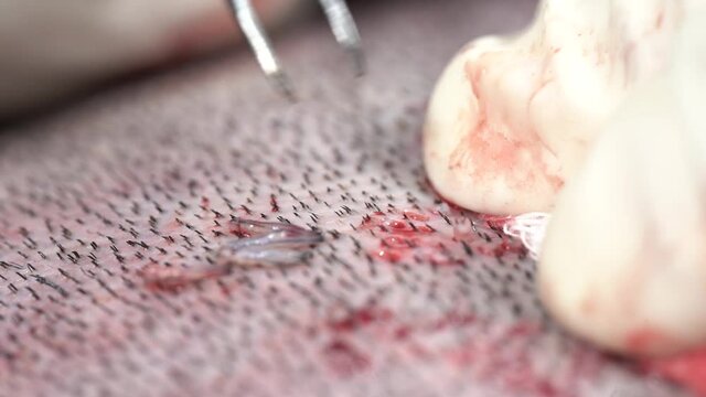 hair transplant