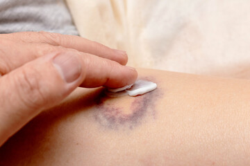 Applying ointment on the hematoma. Hematoma treatment