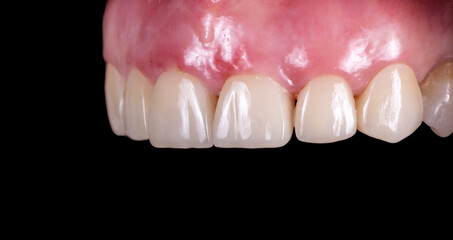 press ceramic crowns and veneers