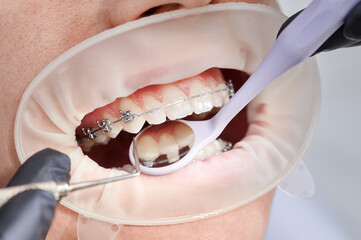 Close up of orthodontist placing orthodontic brackets on patient teeth. Person with cheek retractor...