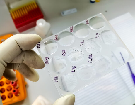 RPR, VDRL, Syphilis test glass slide agglutination method, showing reactive and nonreactive result