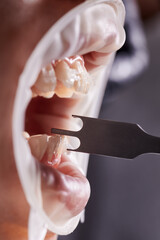 Close up of orthodontist checking height of bracket placement with aluminum gauge. Patient with...